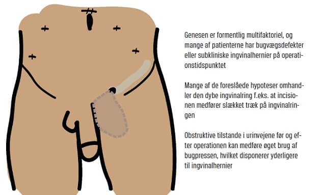 Nedre abdomen med optegning af venstresidig ingvinalkanal, indirekte ingvinalhernie og porthuller, som laves ved robotassisteret radikal prostatektomi. (Illustration: Anders Emil Schack). * 