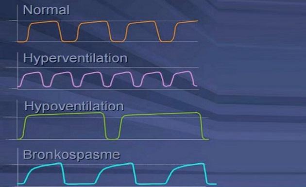 © Skematisk kapnogram ved hhv. normal ventilation, hyperventilation, hypoventilation og hos patienter med bronkospasme.