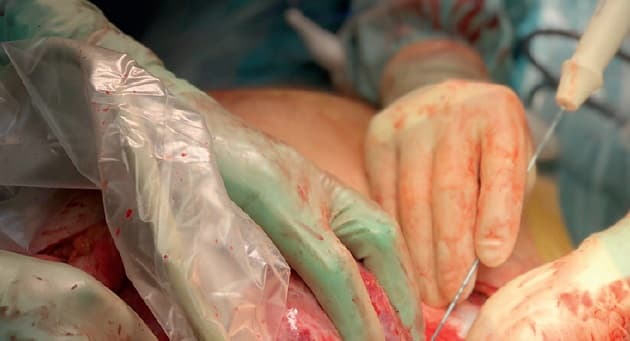 © Radiofrekvensablation under laparotomi.