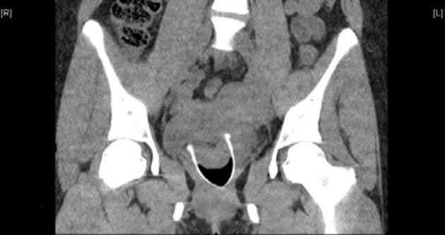 CT-urografi. Der ses højresidig hydronefrose samt en cystisk proces i milten. Endvidere ses et fremmedlegeme i vagina.