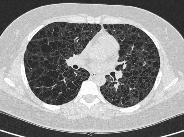 High-resolution computed tomography af lungerne hos en patient med tuberøs sklerose-kompleks og lymfangioleiomyomatose.