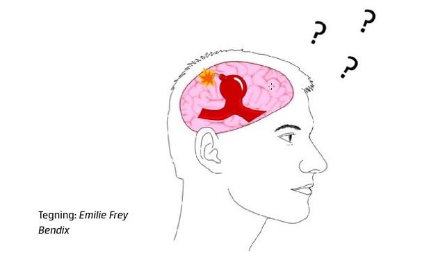 Et ikkerumperet intrakranielt aneurisme opfattes af mange som en tikkende bombe.