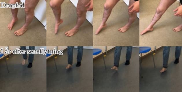 Stillbilleder af en patients gang før og efter seneflytning.