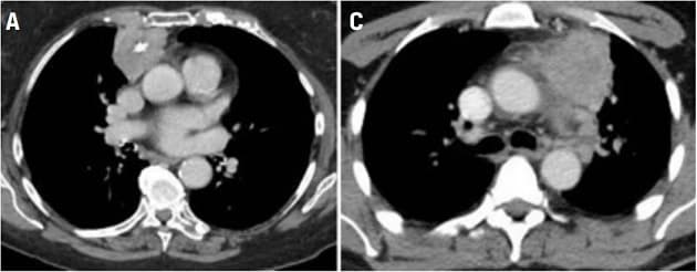  Eksempler på CT-billeder af tymom/thymuskarcinom med kontrast. 
