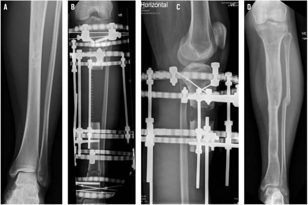 FIGUR 3 / A. Adamantinom i tibia præoperativt. B. Ringfiksation af knogledefekt efter tumorresektion. C. Knoglenydannelse. D. Postoperativt resultat med knogleopheling.