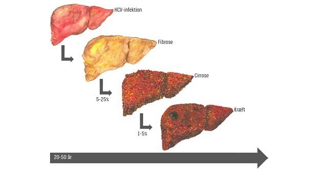 Udviklingen over tid fra kronisk hepatitis C-virus (HCV)-infektion til fibrose, levercirrose og hepatocellulært karcinom.