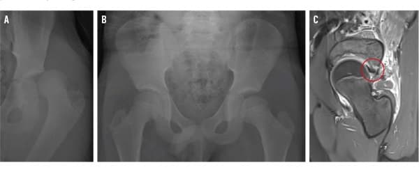 Venstresidig hofteluksation