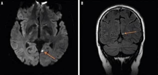 MR-skanningsbillede af en hjerne med et subakut iskæmisk infarkt i venstre praecuneus.