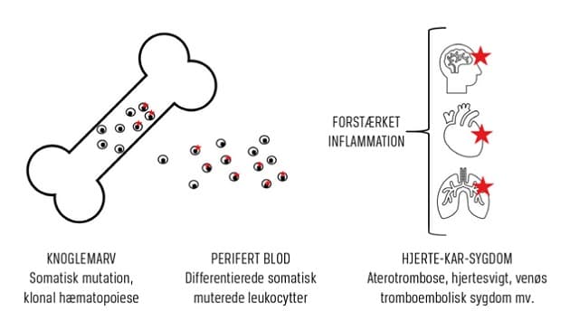 Skematisk fremstilling af sammenhængen mellem klonal hæmatopoiese og hjerte-kar-sygdom.