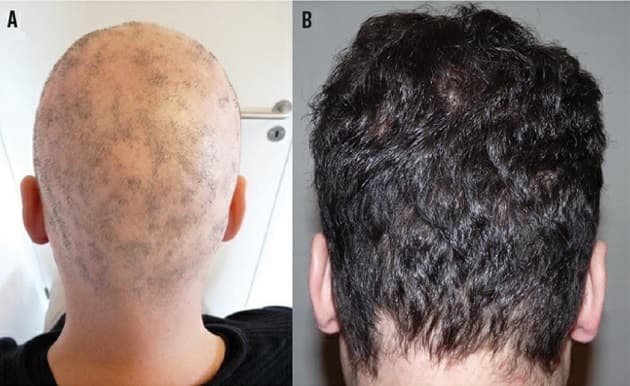 A: Alopecia totalis hos patienten i sygehistorien før behandling. B: Efter seks måneders behandling med tofacitinib. 