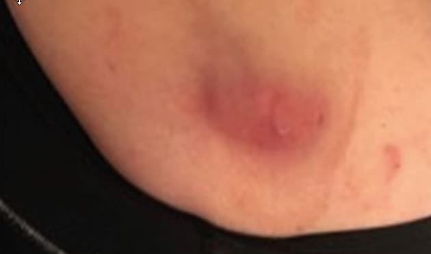 Absces i venstre mamma i bh-kanten op mod aksillen (PRIVATFOTO)