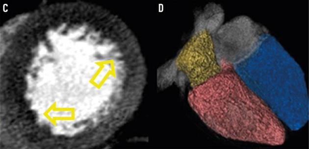 Eksempler på billeddannelse med hjerte-CT. 