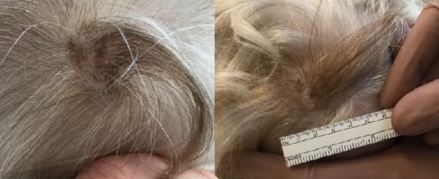 Den pigmenterede hårlok hos patienten i sygehistorien.