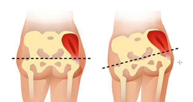 Trendelenburgs tegn.