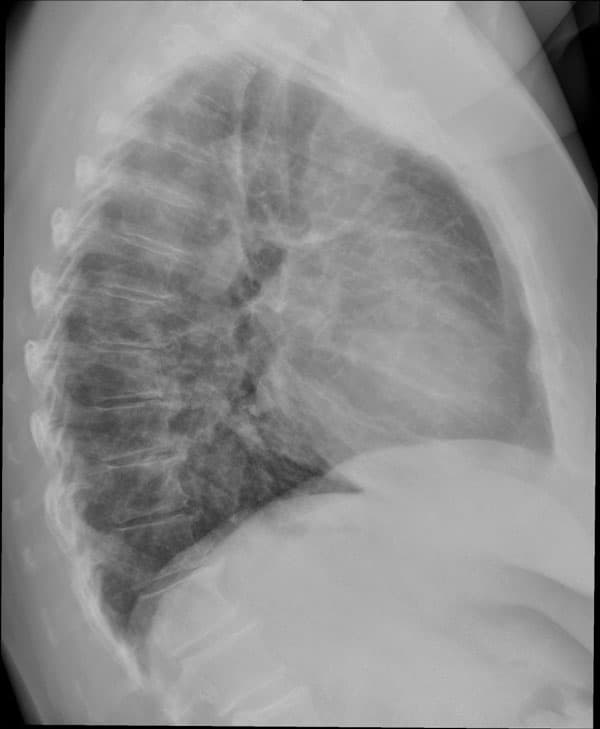 På billedet ses spredte lungeforandringer hos en patient med COVID-19. Billedet er taget 6 uger efter udskrivelsen. Kilde: Infektionsmedicinsk afdeling, OUH.  