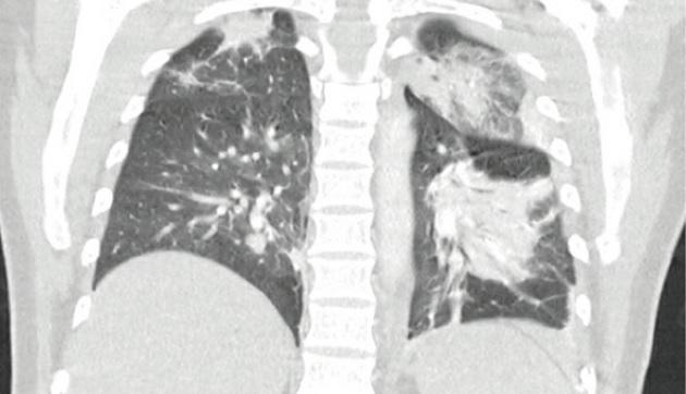 CT-billede af thorax på dag to med bilaterale svære lungeinfiltrationer.