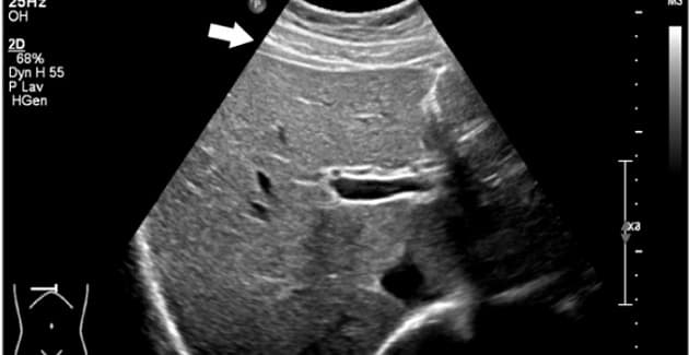 UL skanningsbillede af patientens lever.  