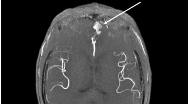 Asymptomatisk cerebral arteriovenøs malformation (pil) hos en 69-årig patient med hereditær hæmoragisk telangiektasi. Gengivet med tilladelse fra patienten.