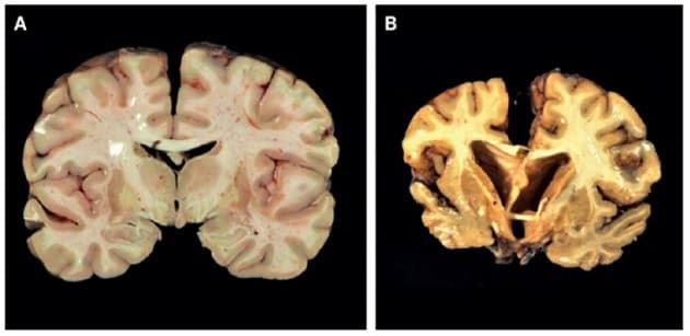 Neurologiske forandringer ved kronisk traumatisk encefalopati.