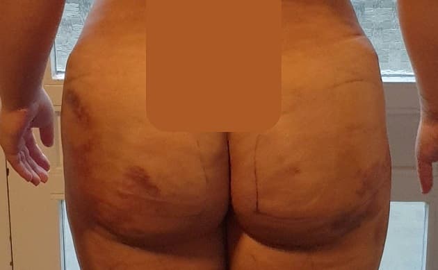 En 28-årig dansk kvinde blev indlagt med fedtembolisyndrom på et dansk sygehus efter athave fået foretaget en Brazilian butt lift-operation i Tyrkiet, hvor man havde fedtsuget 8,5 lfedt fra hhv. mave, ryg, inderlår og overarme og efterfølgende injiceret 2 l fedt i hver balle.(Billedet bringes med tilladelse fra patienten)