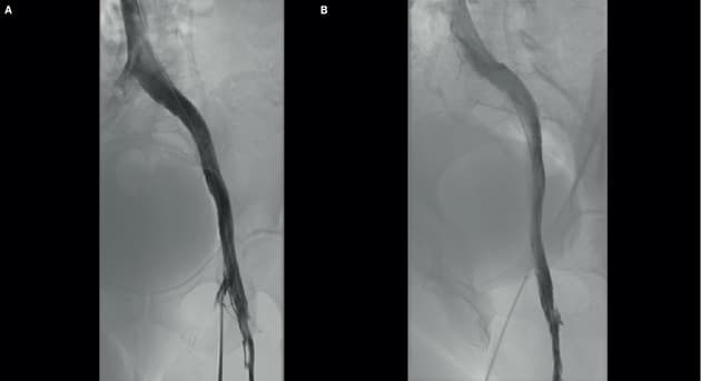 Digital subtraktoinsflebografi. (Ugeskr Læger 2021;183:V01210067)