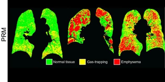 Parametric response maps af thorax.