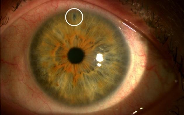 Foto af iridotomi. Iridotomi er et cirka 200 µm hul i iris. Hullet laves med laser, hvorved en eventuel trykdifference over iris elimineres.