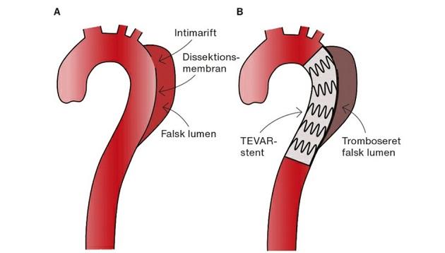 Illustration af type B-aortadissektion. 