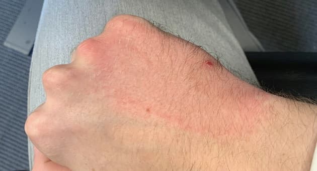 Erythema migrans. Billedet er gengivet med patientens tilladelse. . Ugeskr Læger 2022;184:V03210248