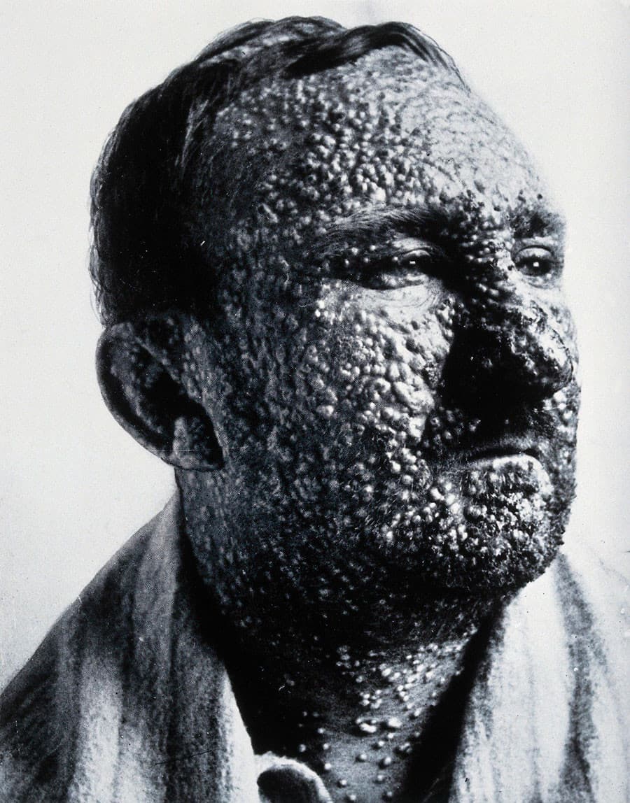 Koppepatient, ca. 1900. The Wellcome Collection.