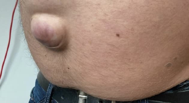 Patient med cirrose og umbilikalhernie