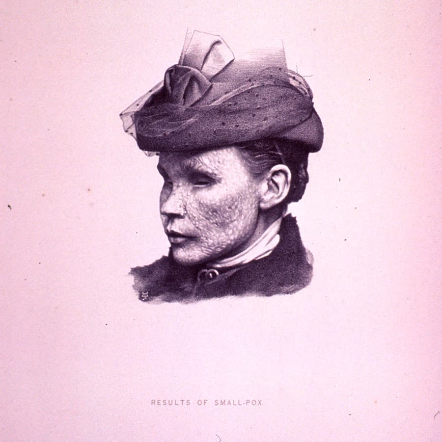 Overlevende efter koppeangreb kunne være dækket af vansirende ar. Foto fra slutningen af 1800-tallet. Foto: National Library of Medicine.