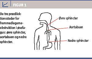 Håndtering af fremmedlegeme i øsofagus med synkestop | Ugeskriftet.dk