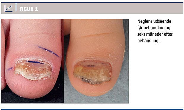 hos små børn sjælden, og behandlingen er en dermatologisk specialopgave | Ugeskriftet.dk