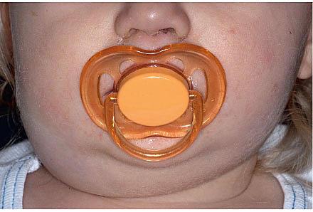 Right-sided cervical lymphadenopathy.