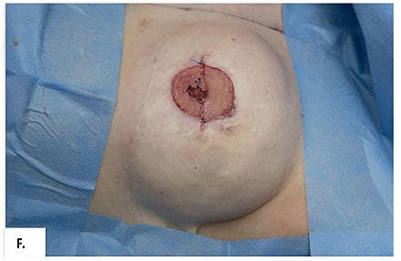 The nipple is reconstructed and the donor defect is closed.