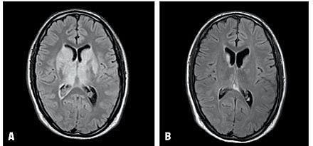 Magnetic resonance imaging flair illustrating central oedema in patient ID 2 prior to endovascular treatment (A) and after 72 h of thrombolysis (B). Note the diminished central cerebral oedema after recanalization.