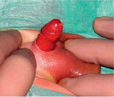 Complete excision of all penile skin as a complication to newborn male circumcision.