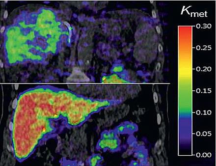 Galaktose-PET/CT af en lever med cirrose (øverst) og en normal lever (nederst).