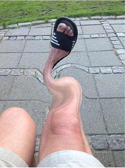 Er der en sammenhæng mellem restless legs syndrome og attention deficit hyperactivity disorder?