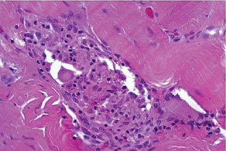 Skeletmuskulatur med nonnekrotiserende granulom.
