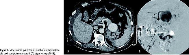 Endovaskulært behandlet rumperet aneurisme på arteria lienalis ...