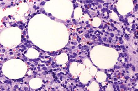 Histologisk undersøgelse af knoglemarven viste beskeden opmodning af myelopoiesen og ca. 20% differentieringskompleks (CD)34-, CD117- og myeloperoxidasepositive blastceller. Hæmatoxylin-eosin-farvet snit fra cristabiopsien, × 20.