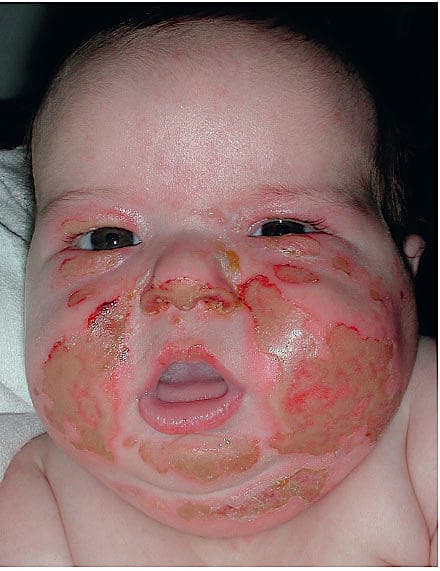 Et tre måneder gammelt barn med ansigtsforbrænding.