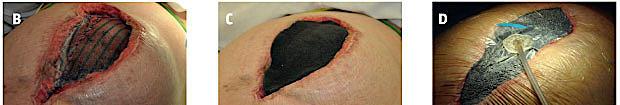 Photographs of layers in vacuum-assisted wound closure and mesh-mediated fascial traction.