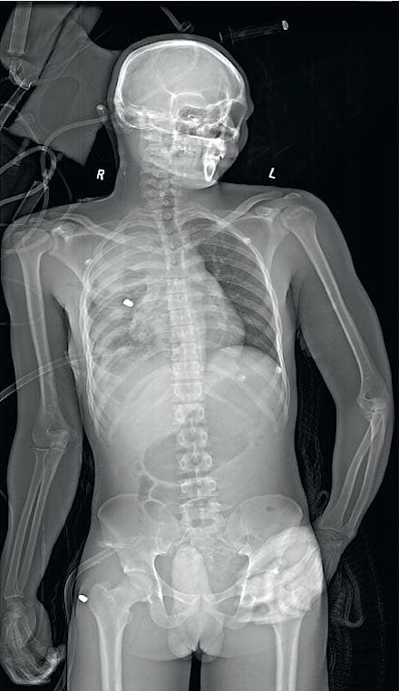 Røntgenbillede af en traumepatient med projektiler siddende i højre thorax og lår.