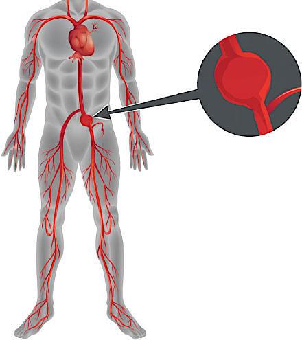 Illustration af aneurisme på arteria iliaca communis.