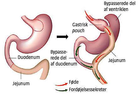 Graviditet efter gastrisk bypass.