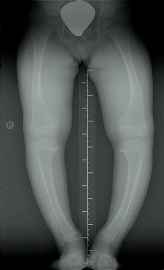 Røntgenbillede af en pige med genu varum pga. X-bundet dominant hypofosfatæmisk rakitis.