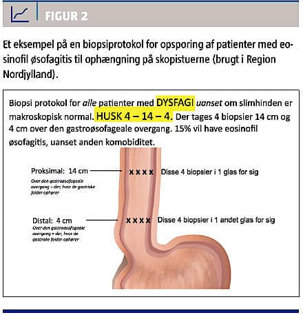 Eosinofil øsofagitis hos voksne | Ugeskriftet.dk